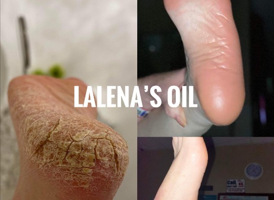 What is Lalenas Oil?